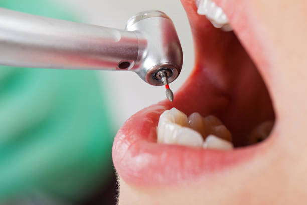 Best Emergency Treatment for Dental Infections or Abscesses in Oxon Hill, MD